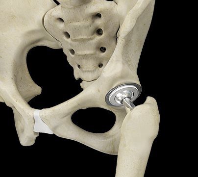 Anterior Total Hip Replacement