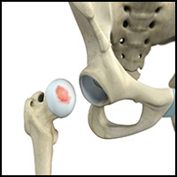Chondral Injuries of Hip
